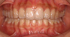 invisalign-img01-2