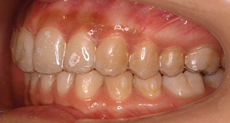 invisalign-img01-3